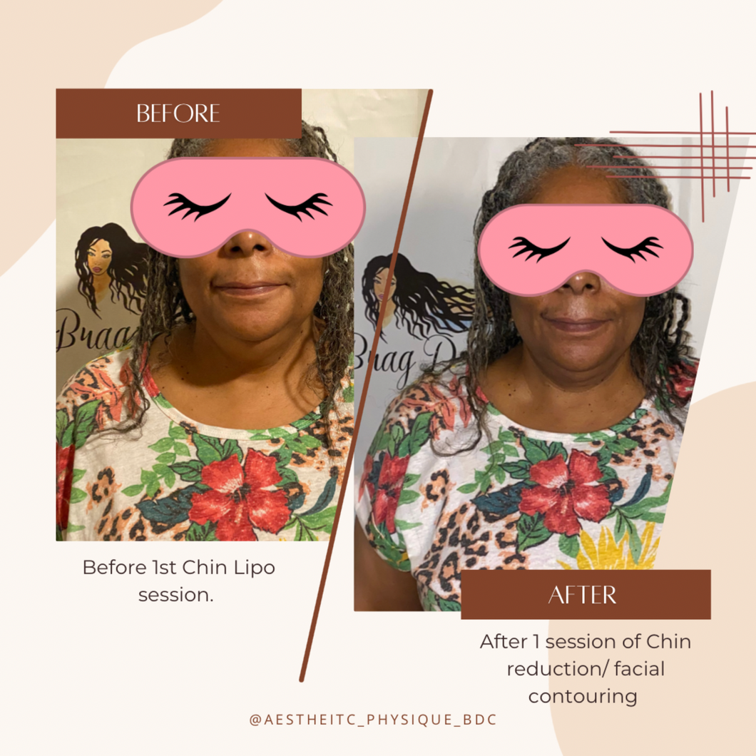 Double Chin Removal/ Facial Contouring