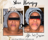 LED Light Skin Therapy- Scar Reduction Treatment